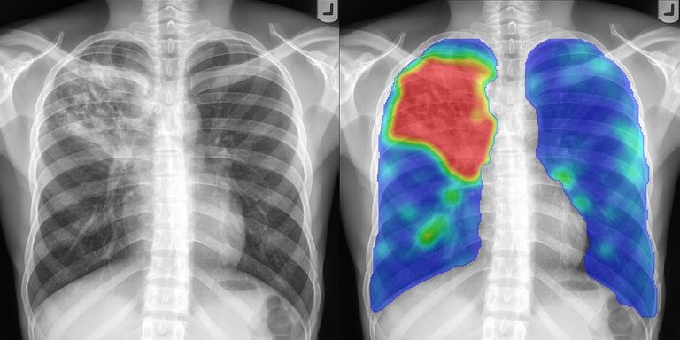 COVIZN : AI-based COVID-19 Screening Software